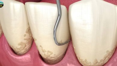 teeth scaling and root planing